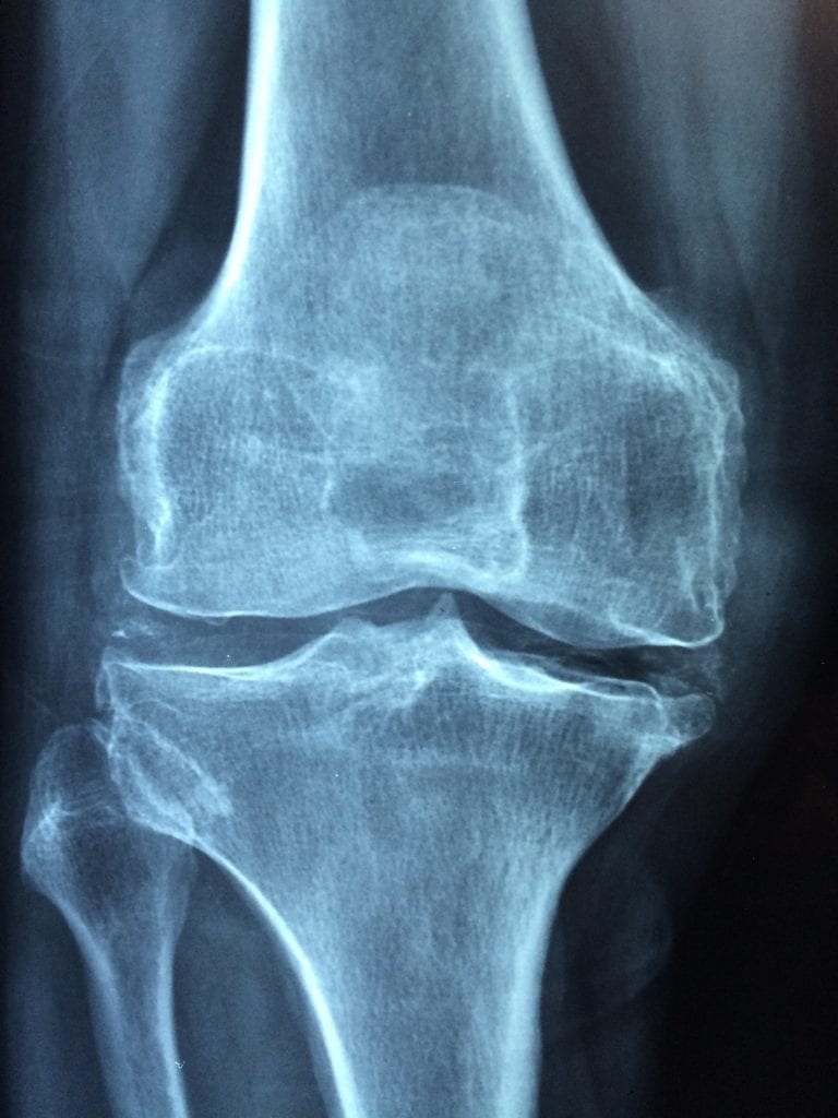 knee arthritis